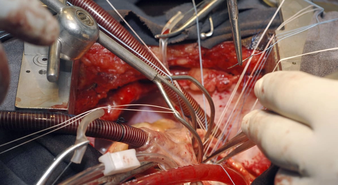Surgeons performing a heart transplant surgery in an operating room
